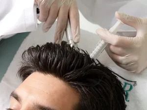 عکس مزوتراپی مو