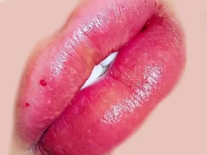 مزایای تزریق ژل لب مدل چاکدار